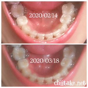 インプラント矯正-1ヵ月での歯の動き-上から見る下の歯 202002