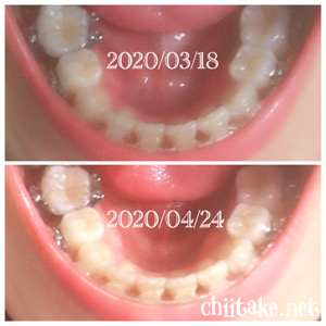 インプラント矯正-1ヵ月での歯の動き-上から見る下の歯 202004