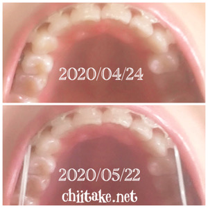 インプラント矯正-1ヵ月での歯の動き-下から見る上の歯 202005