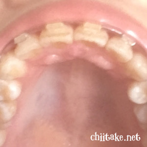 歯列矯正 - 前歯の段差(?) 202006