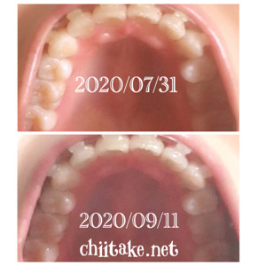 インプラント矯正-1ヵ月半の歯の動き-下から見る上の歯 202009
