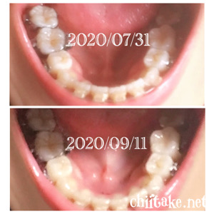 インプラント矯正 - 1ヵ月半の歯の動き-上から見る下の歯 202009