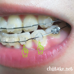 インプラント矯正 - 左犬歯の先端が噛み合わない処置 20200911