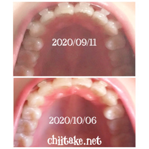 インプラント矯正-1ヵ月半の歯の動き-下から見る上の歯 202010