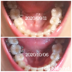 インプラント矯正 - 1ヵ月半の歯の動き-上から見る下の歯 202010