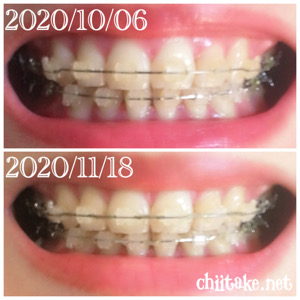 インプラント矯正 - 前歯の被さり 比較 202011