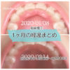 インプラント矯正 歯の動き経過まとめ 20200108-20200213