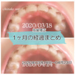 インプラント矯正 歯の動き経過まとめ 20200317-20200423