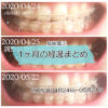 インプラント矯正 歯の動き経過まとめ 20200424-20200521