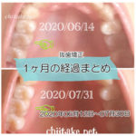 インプラント矯正 歯の動き経過まとめ 20200611-20200730