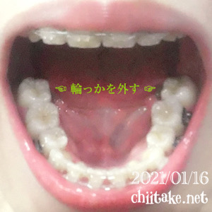 アンカースクリュー抜歯矯正 下の一番奥の歯の輪っか(バンド)を外す 202101