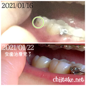 歯列矯正 装置の下に出来た虫歯治療 ビフォーアフター写真 20210122