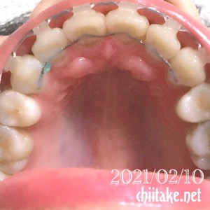 歯列矯正 ブラケットオフの準備 上前歯の裏に針金を装着 20210210