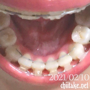 歯列矯正 ブラケットオフの準備 下前歯の裏に針金を装着 20210210