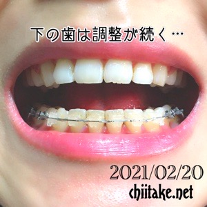 歯列矯正 上の歯は装置が外れたけど下の歯は調整が続く 20210220
