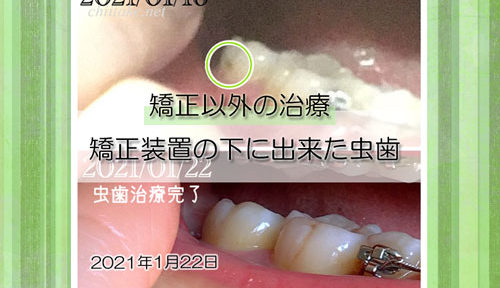 歯列矯正 装置の下に出来た虫歯治療 20210122