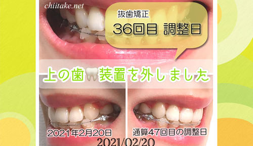 インプラント矯正 36回目調整日 上の歯ブラケットオフ 20210210