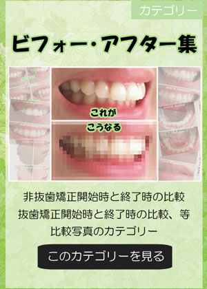 出っ歯の歯列矯正_ビフォー・アフター写真