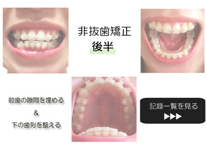 出っ歯の非抜歯矯正-前歯の隙間を埋める